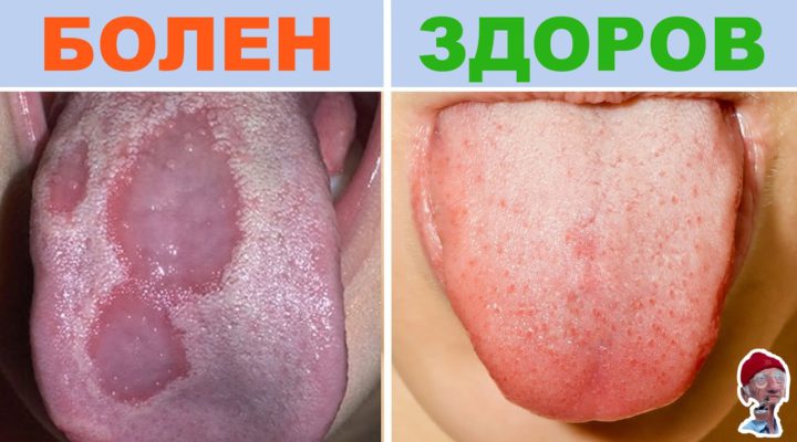 ПРОВЕРЬТЕ ЦВЕТ СВОЕГО ЯЗЫКА! 10 ПРИЗНАКОВ БОЛЕЗНИ по цвету языка (Check the color of your tongue! 10 SIGNS OF DISEASE IN a tongue color.)